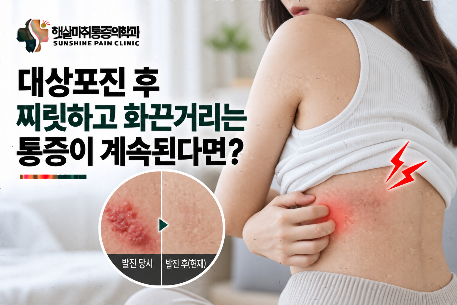 대상포진 후 찌릿하고 화끈거리는 통증이 계속된다면