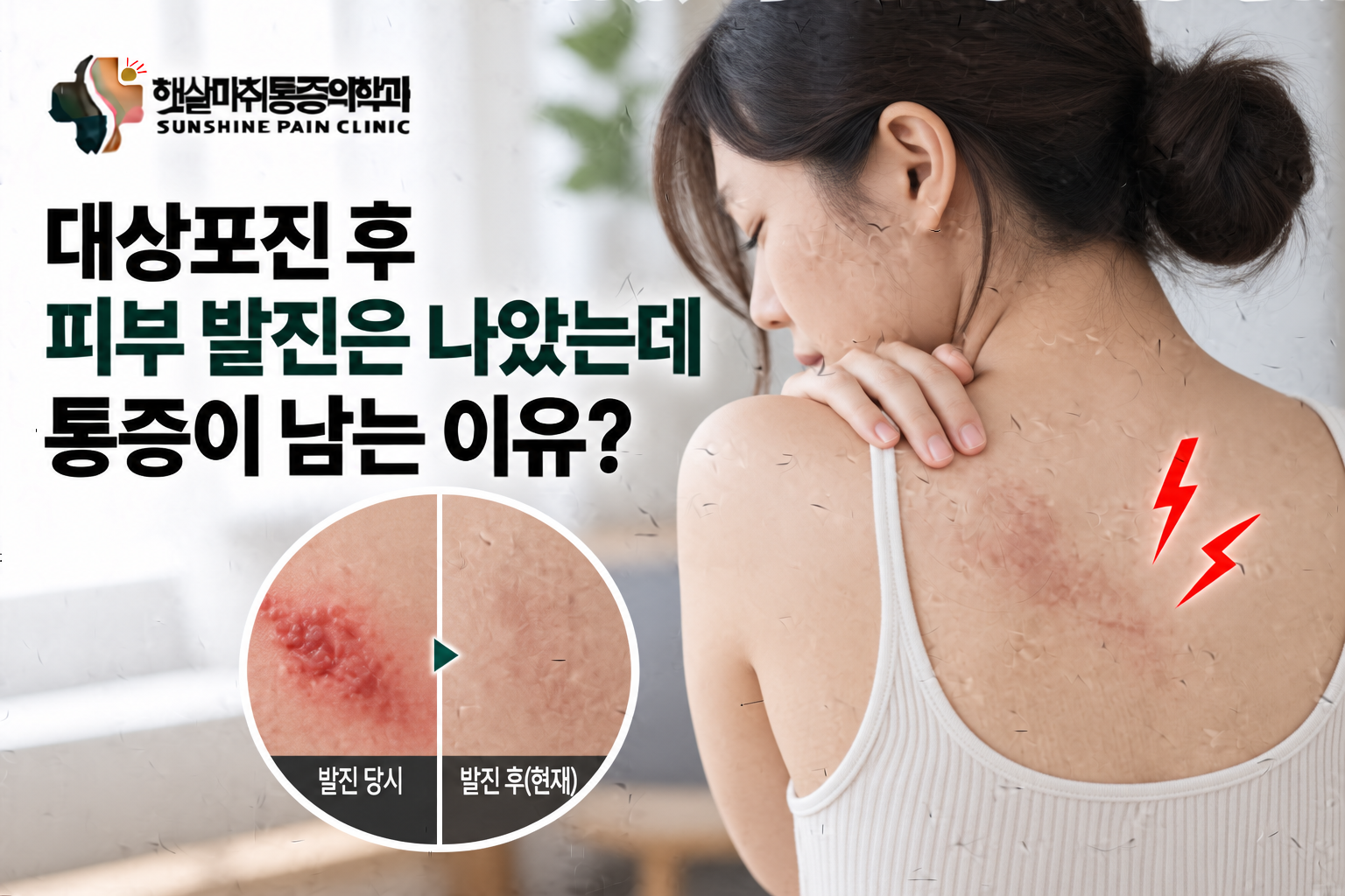 대상포진 후 피부 발진은 나았는데 통증이 남는 이유